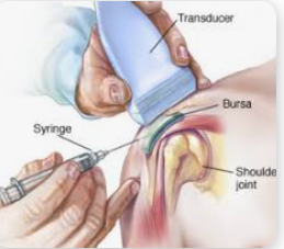 Image of a Steroid Injection into the Knee