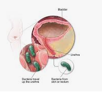 Image of a UTI
